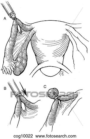 Sterilization, Falope Ring View Large Illustration Drawing - Sterilization, Falope Ring. Fotosearch