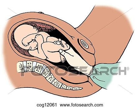 Twin gestation, breech delivery, step 1 View Large Illustration Clip Art - Twin gestation, breech delivery, step 1. Fotosearch