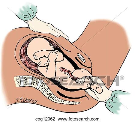 Twin gestation, vertex/nonvertex, breech delivery, View Large Illustration Drawing - Twin gestation, vertex/nonvertex, breech delivery,. Fotosearch
