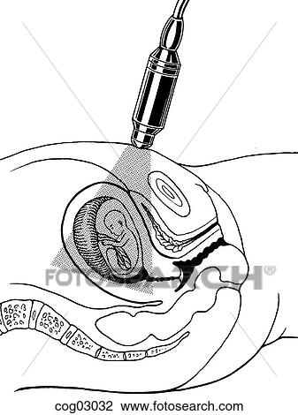 Drawing - Ultrasonography, transabdominal. Fotosearch