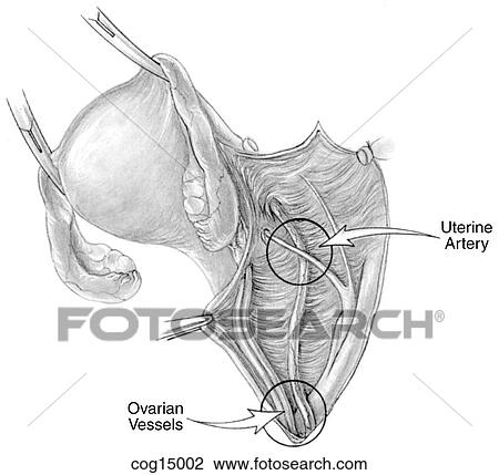 Drawing - Ureter injury. Fotosearch