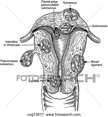Stock Illustration - Uterine fibroids, common types. Fotosearch