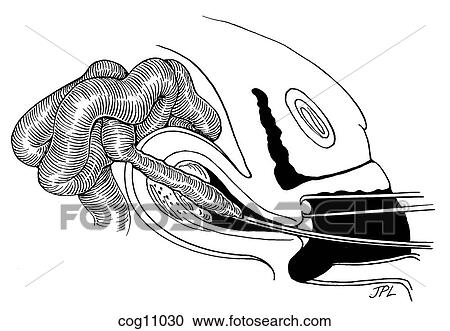 Clipart - Uterine fundal perforation with suction curette. Fotosearch