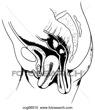 Stock Illustration - Uterus, prolapse. Fotosearch
