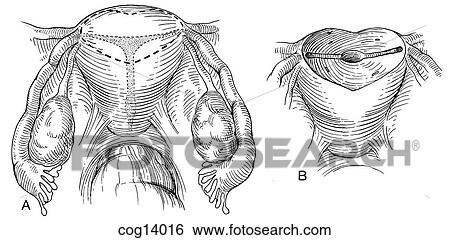 Uterus, T-shaped--corrective surgery, part 1 View Large Illustration Stock Illustration - Uterus, T-shaped--corrective surgery, part 1. Fotosearch
