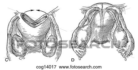 Uterus, T-shaped--corrective surgery, part 2 View Large Illustration Stock Illustration - Uterus, T-shaped--corrective surgery, part 2. Fotosearch