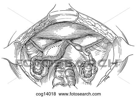 Stock Illustration - Uterus, unicornuate. Fotosearch
