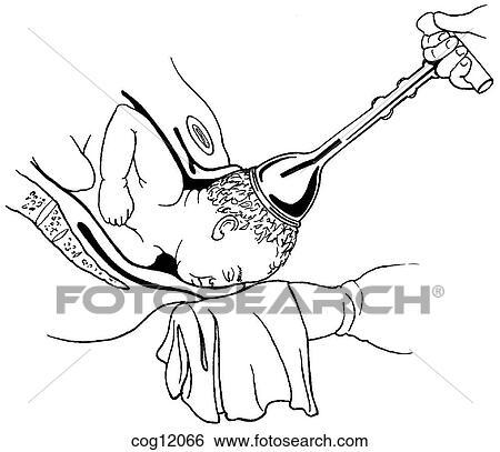 Stock Illustration - Vacuum extraction. Fotosearch