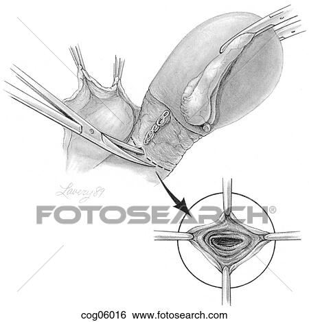 Stock Illustration - Vaginal dissection in abdominal hysterectomy. Fotosearch