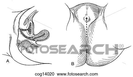 Clipart - Vaginal reconstruction, part 1. Fotosearch