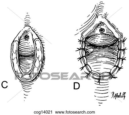 Clip Art - Vaginal reconstruction, part 2. Fotosearch