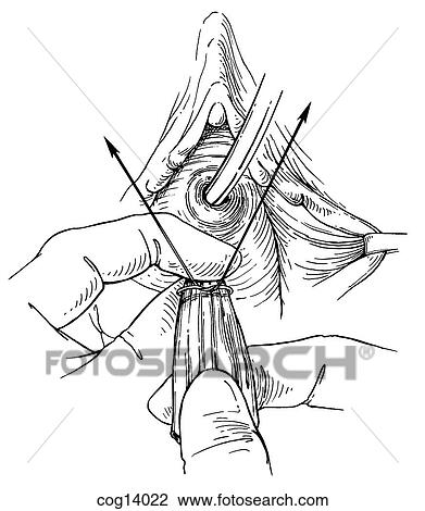 Vaginal reconstructive surgery, part 1 View Large Illustration Drawing - Vaginal reconstructive surgery, part 1. Fotosearch
