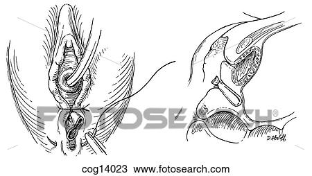 Vaginal reconstructive surgery, part 2 View Large Illustration Drawing - Vaginal reconstructive surgery, part 2. Fotosearch