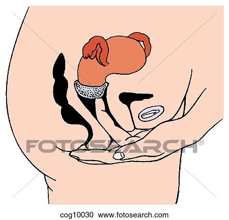 Vaginal sponge, insertion technique, step 2 View Large Illustration Clipart - Vaginal sponge, insertion technique, step 2. Fotosearch