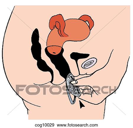 Vaginal sponge, insertion technique, step 1 View Large Illustration Stock Illustration - Vaginal sponge, insertion technique, step 1. Fotosearch