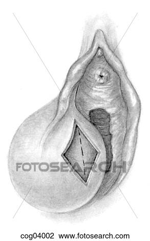 Drawing - Vulvar disease, Bartholin's gland cyst, step 2. Fotosearch
