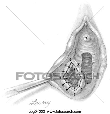 Drawing - Vulvar disease, Bartholin's gland cyst, step 3. Fotosearch