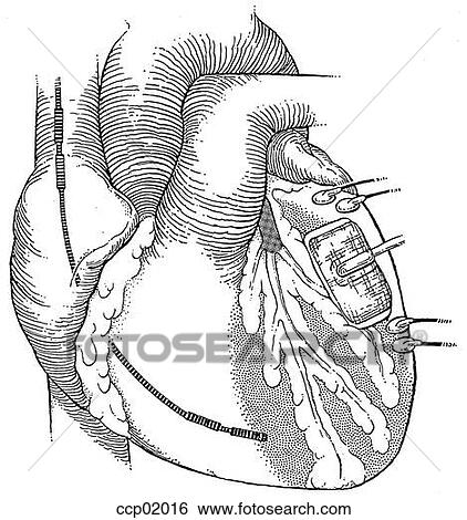 心臓 ペースメーカー イラスト Ccp016 Fotosearch