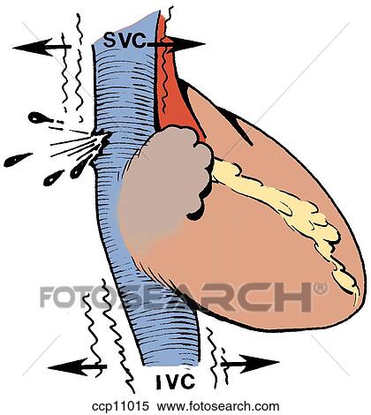 心臓 破裂 減速度 メカニズム イラスト Ccp Fotosearch