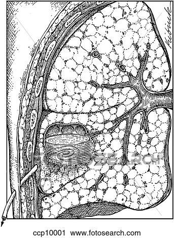 Clip Art - Abscess drainage. Fotosearch
