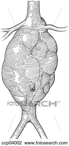 Aneurysm, abdominal aortic View Large Illustration Drawing - Aneurysm, abdominal aortic. Fotosearch