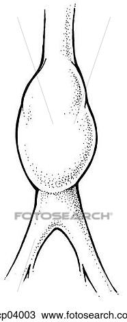 Drawing - Aneurysm, aortic. Fotosearch
