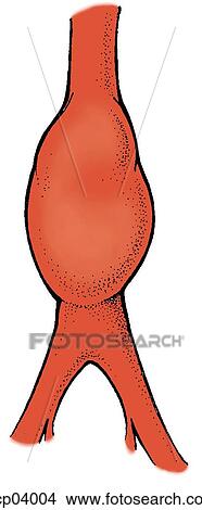Stock Illustration - Aneurysm, aortic. Fotosearch