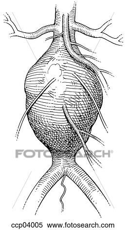 Stock Illustration - Aneurysm, aortic. Fotosearch