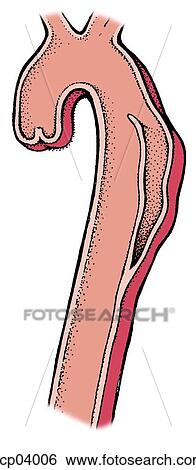 Stock Illustration - Aneurysm, dissecting. Fotosearch