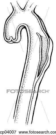 Aneurysm, dissecting View Large Illustration Stock Illustration - Aneurysm, dissecting. Fotosearch
