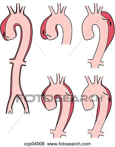 Stock Illustration - Aneurysms, aortic. Fotosearch