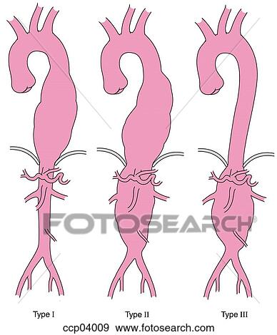 Aneurysms, aortic View Large Illustration Stock Illustration - Aneurysms, aortic. Fotosearch