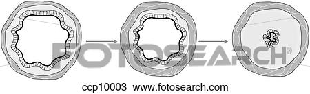 Drawing - Asthma. Fotosearch
