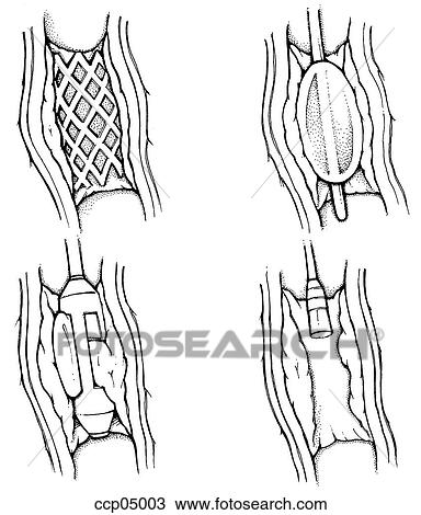 Drawing - Atherosclerosis, treatment. Fotosearch