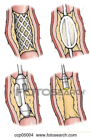 Stock Illustration - Atherosclerosis, treatment. Fotosearch