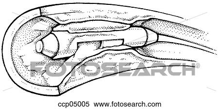 Atherosclerosis, treatment View Large Illustration Stock Illustration - Atherosclerosis, treatment. Fotosearch