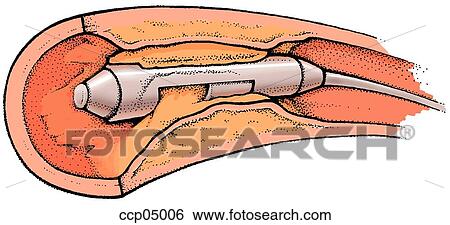 Atherosclerosis, treatment View Large Illustration Stock Illustration - Atherosclerosis, treatment. Fotosearch