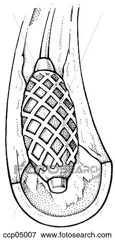 Stock Illustration - Atherosclerosis, treatment. Fotosearch