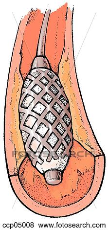 Stock Illustration - Atherosclerosis, treatment. Fotosearch