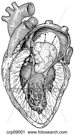 Clip Art - Atrial myxoma, rapid growth. Fotosearch