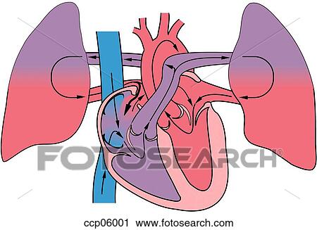 Atrial septal defect, isolated View Large Illustration Clip Art - Atrial septal defect, isolated. Fotosearch