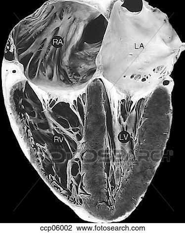 Atrioventricular connection View Large Illustration Drawing - Atrioventricular connection. Fotosearch