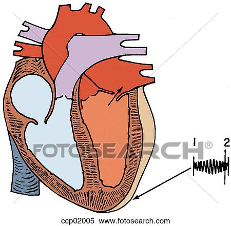 Auscultation, mitral regurgitation View Large Illustration Stock Illustration - Auscultation, mitral regurgitation. Fotosearch