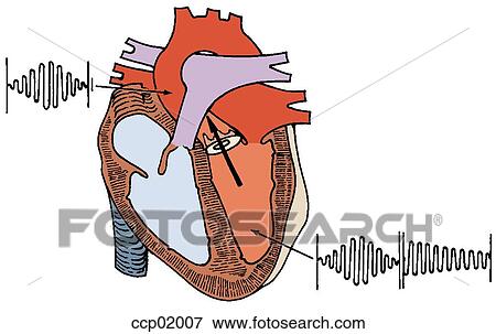 Auscultation, subvalvular membranous stenosis View Large Illustration Stock Illustration - Auscultation, subvalvular membranous stenosis. Fotosearch