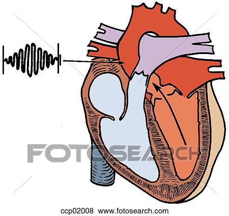 Auscultation, subvalvular membranous stenosis View Large Illustration Stock Illustration - Auscultation, subvalvular membranous stenosis. Fotosearch