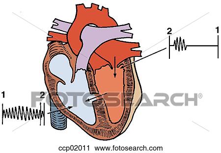 Auscultation, ventricular septal defect View Large Illustration Clip Art - Auscultation, ventricular septal defect. Fotosearch