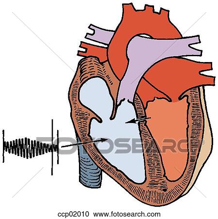 Auscultation, ventricular septal defect View Large Illustration Clipart - Auscultation, ventricular septal defect. Fotosearch