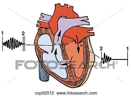 Auscultation, ventricular septal defect View Large Illustration Drawing - Auscultation, ventricular septal defect. Fotosearch