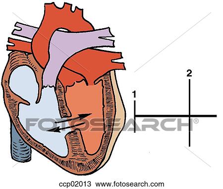 Auscultation, ventricular septal defect View Large Illustration Drawing - Auscultation, ventricular septal defect. Fotosearch