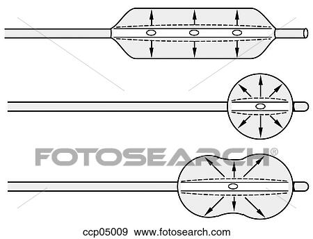 Balloon catheters, types View Large Illustration Stock Illustration - Balloon catheters, types. Fotosearch